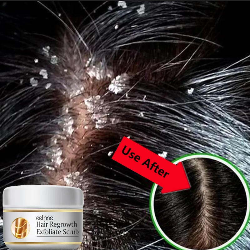สครับขจัดรังแคสูตรเร่งด่วน บรร - Hair Care Dandruff บทวิจารณ์และราคา
